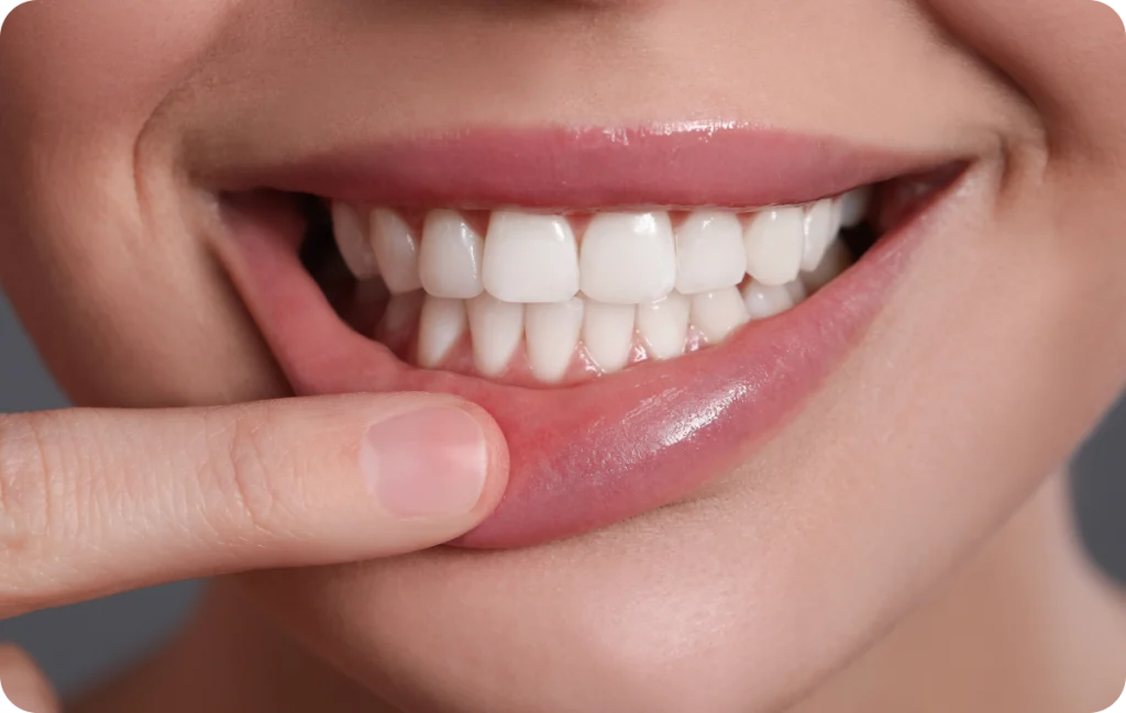 blanchiment dentaire chevreuse sourire eclatant Déchaussement des dents Cabinet Dental Vallée | Dentistes Chevreuse