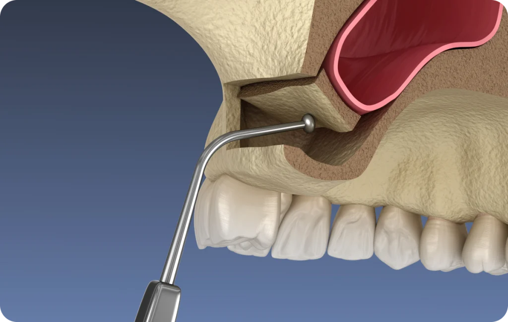 comblement osseux chevreuse Comblement osseux Cabinet Dental Vallée | Dentistes Chevreuse