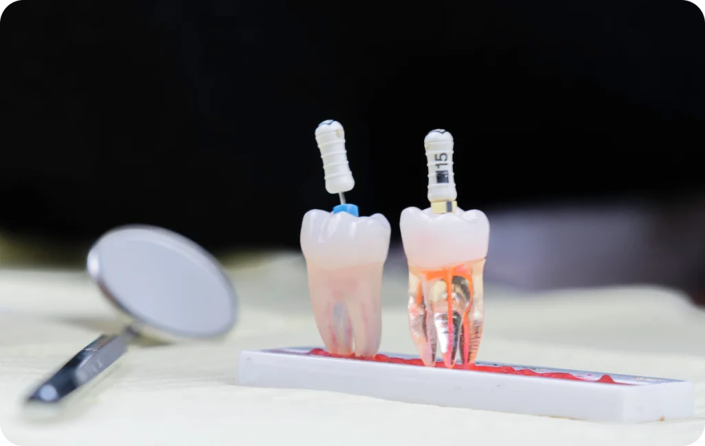 endodontie chevreuse soins profond dent Traitement et retraitement de racine Cabinet Dental Vallée | Dentistes Chevreuse