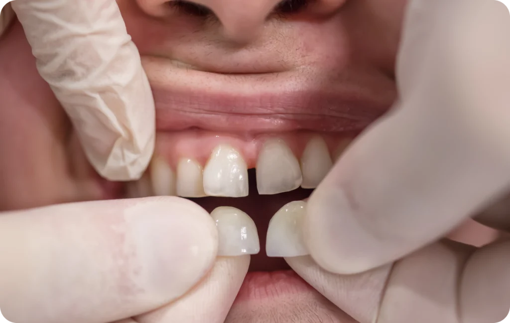 facettes chevreuse esthetique dentaire facettes chevreuse esthetique dentaire Facettes Cabinet Dental Vallée | Dentistes Chevreuse